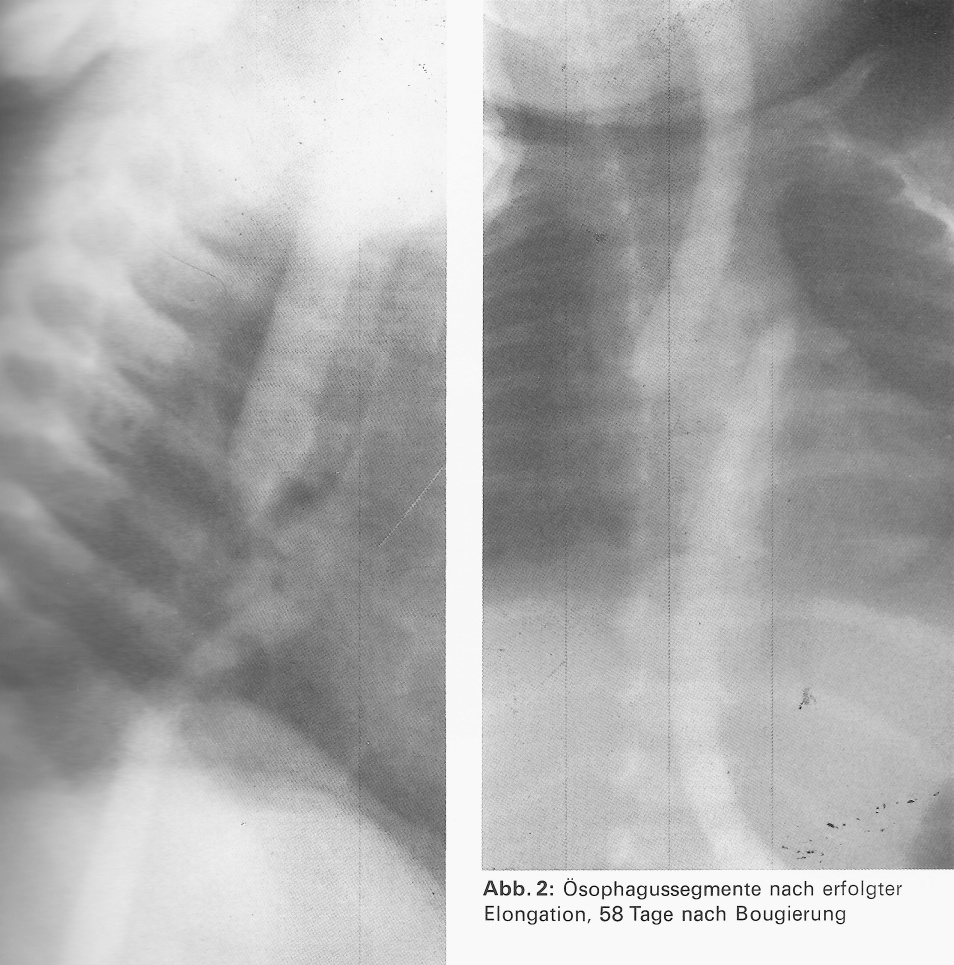 Abb. 20: Oesophagusatresie