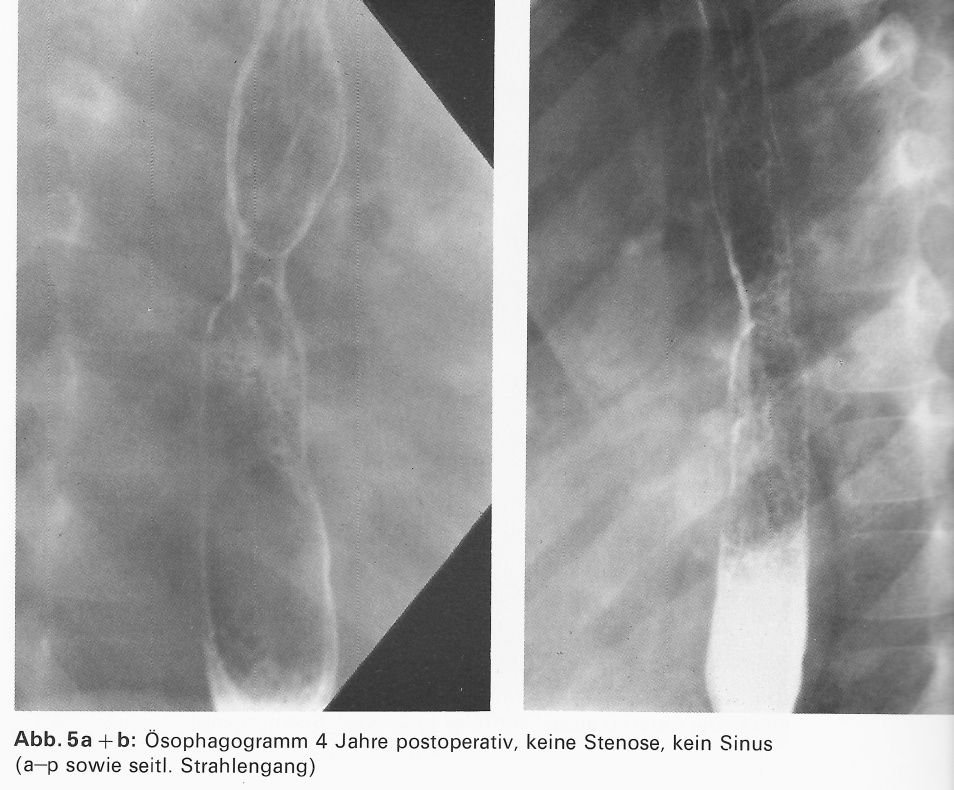 Abb. 21: Oesophagusatresie2